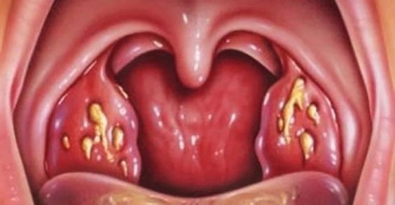 Tonsillite e adenoidite acuta e cronica